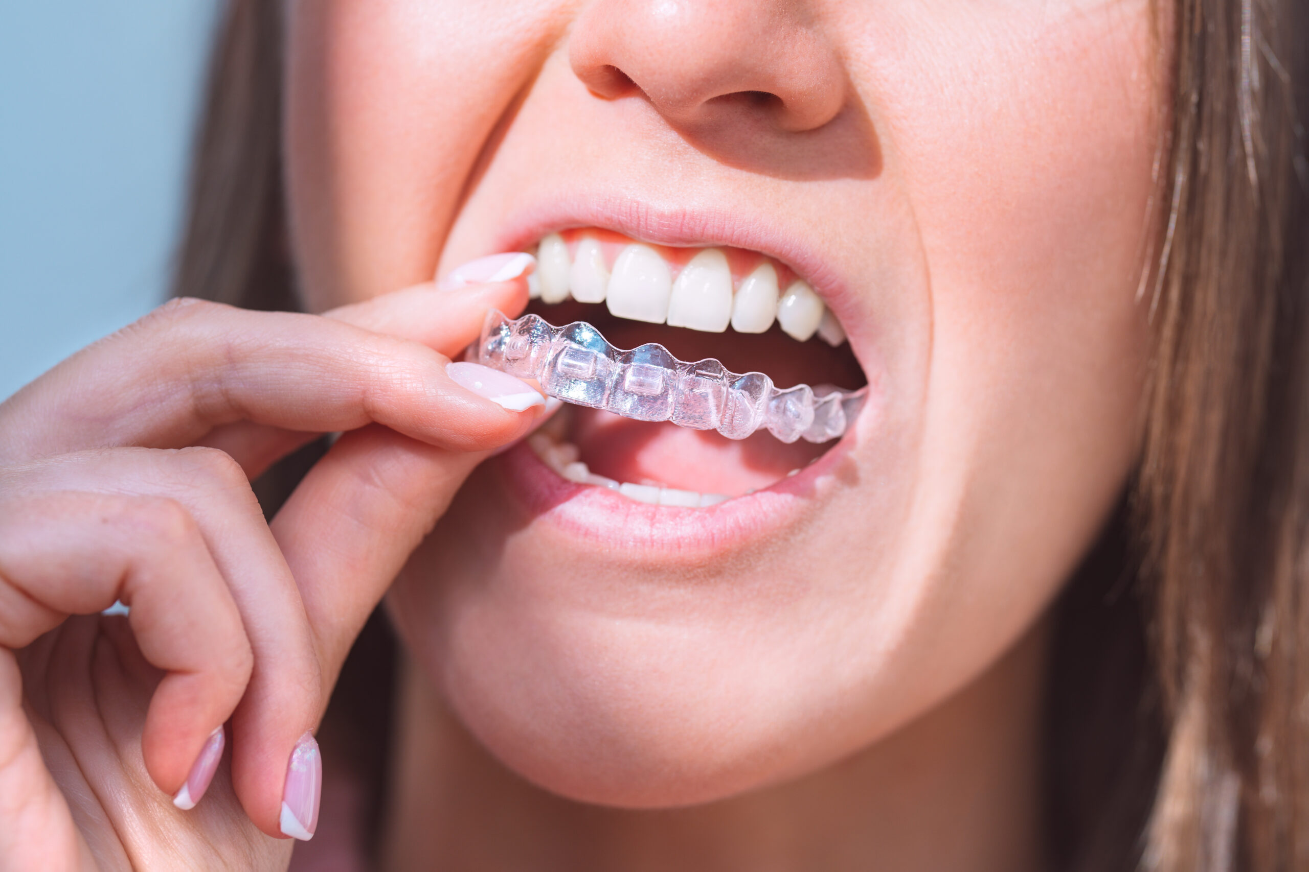 Woman with perfect smile inserting invisible dental aligners for dental correction. High quality photo