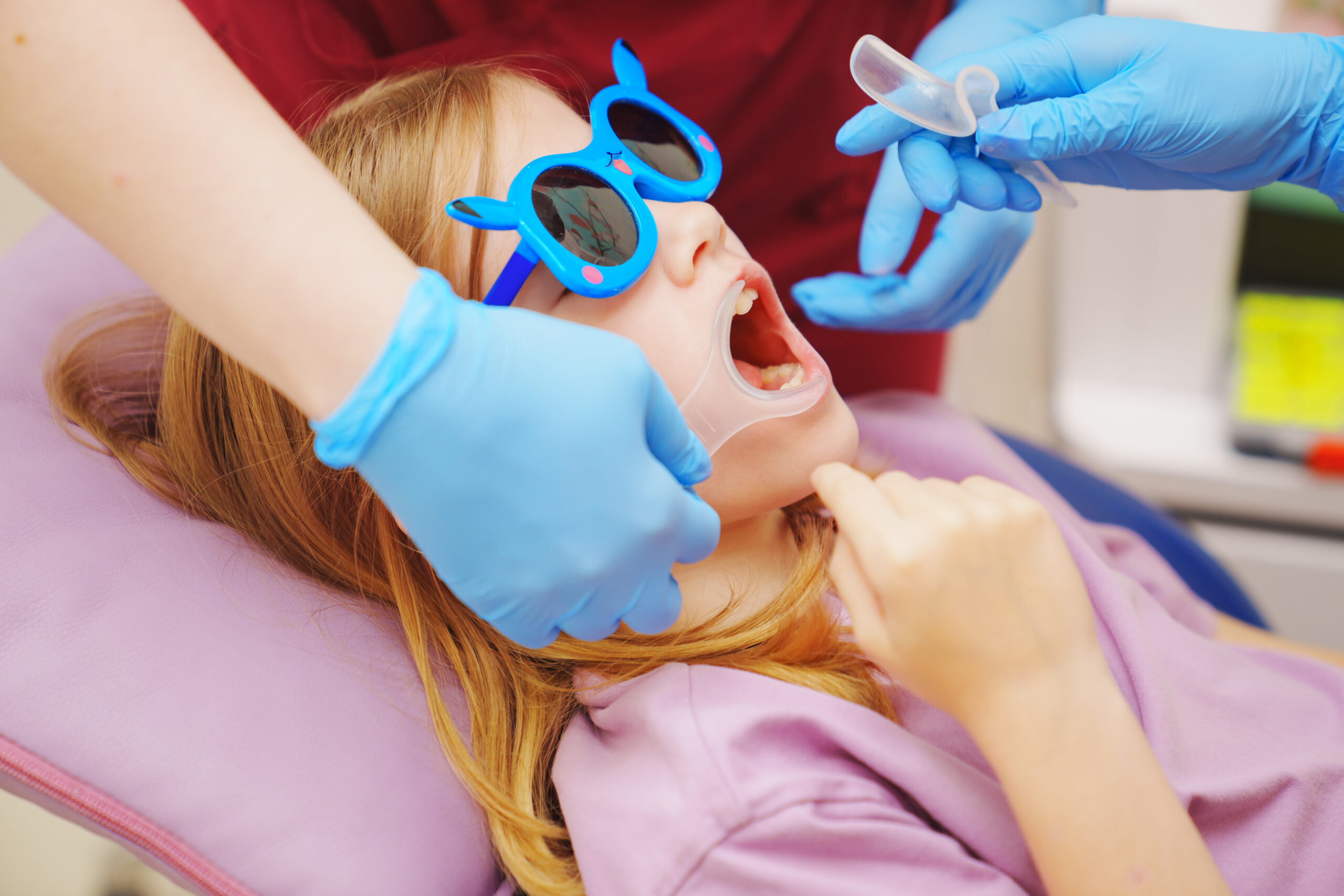 The pediatric dentist installs cheek and lip retractor for takes photos of the teeth before or after treatment. Dental photoprotocol in dentistry.